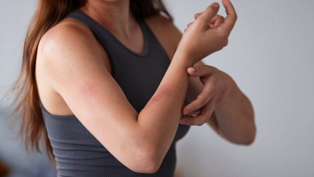 LA CARGA OCULTA DE LA DERMATITIS ATÓPICA